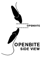 open bite illustration, side view
