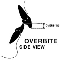 overbite illustration, side view