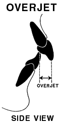 overjet illustration, side view