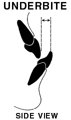 underbite illustration, side view