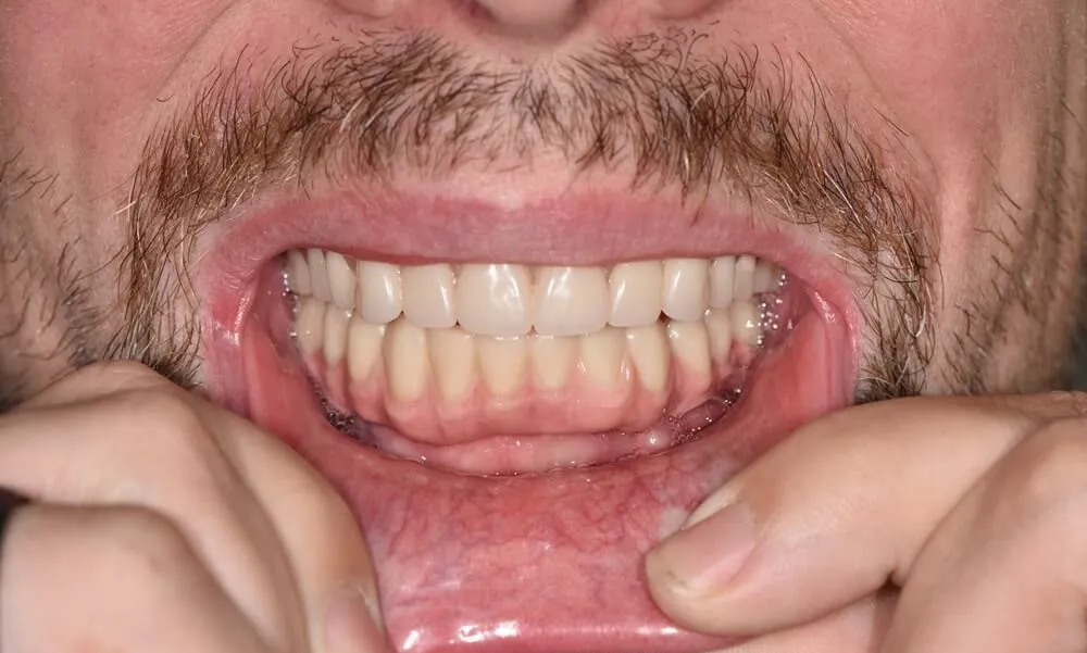 After All-on-X dental implants, showing a fully restored lower arch.