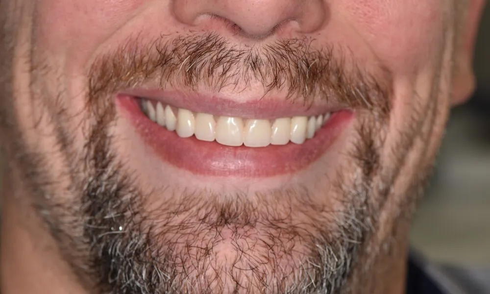 Close-up of completed All-on-X dental implants with natural-looking teeth.