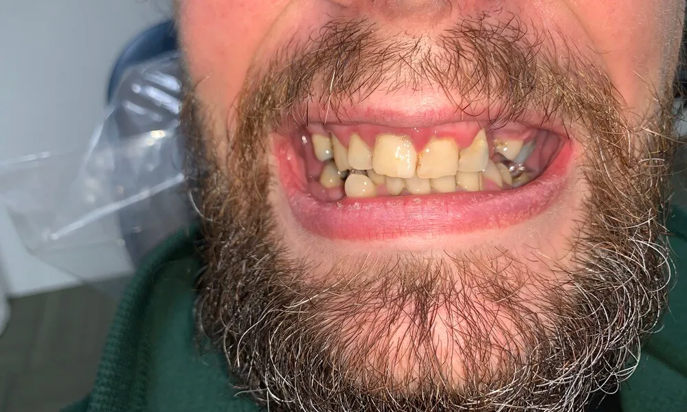 Before All-on-X dental implants, showing missing or damaged teeth.